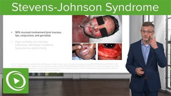 What is Stevens-Johnson syndrome? Condition explored as rapper Ab-Soul opens up about suicide attempt