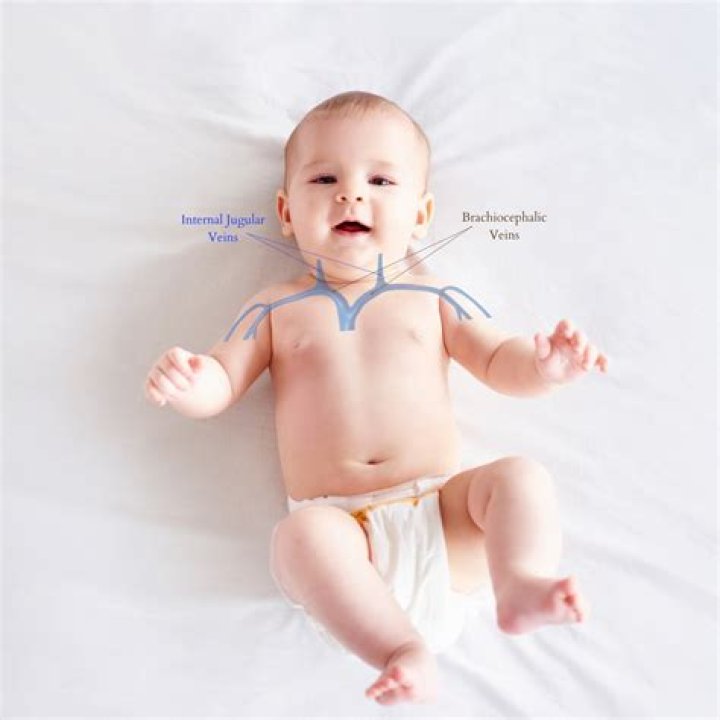 What is the CPT code for brachiocephalic arteriovenous fistula?