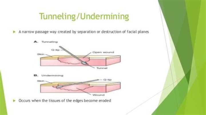 What is the difference between undermining and tunneling?