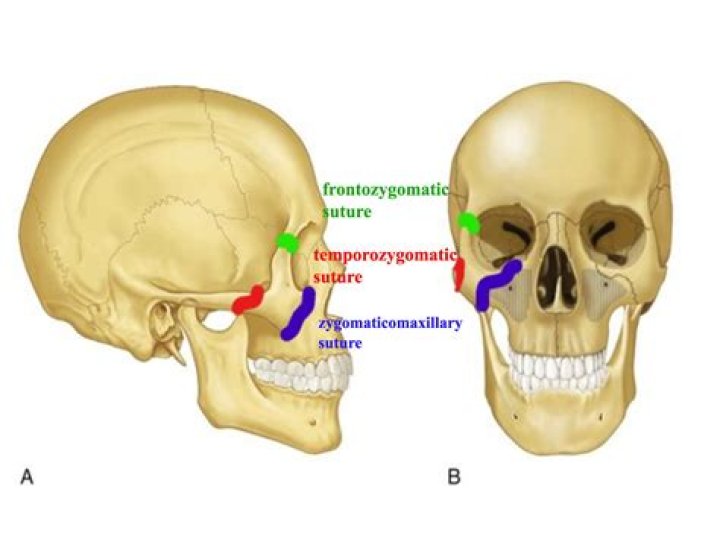 What is the Frontozygomatic suture?