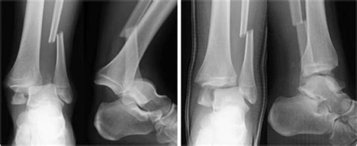 What is the ICD 10 code for right calcaneus fracture?