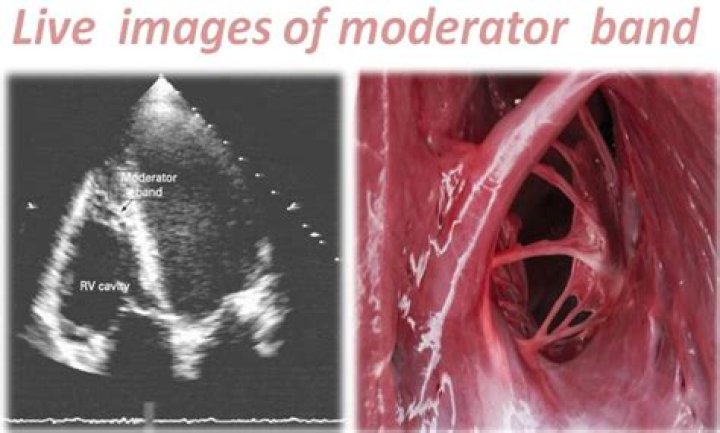 What is the moderator band of the heart?