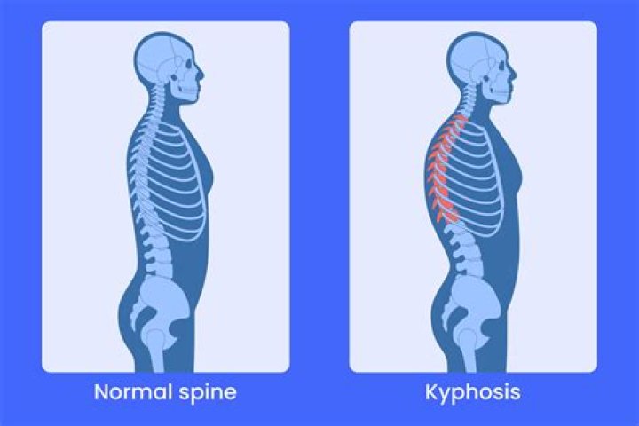 What is Thoracic Hypokyphosis?