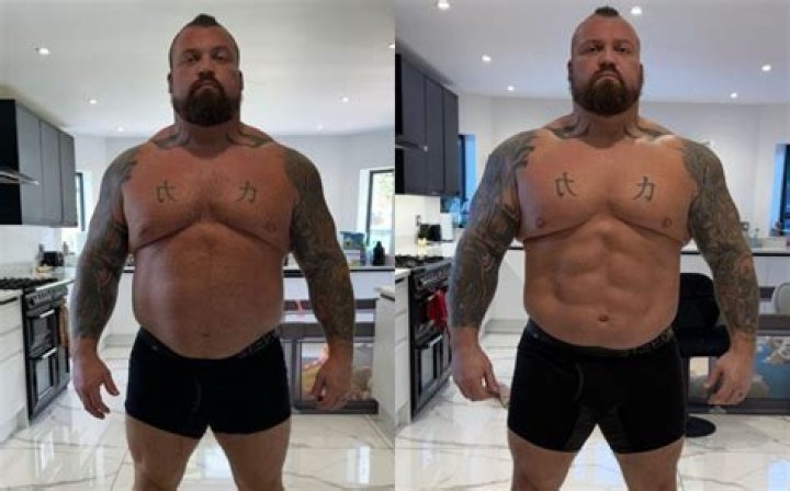What medical condition does Eddie Hall have?