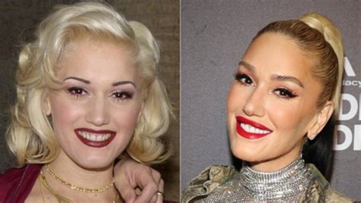 When did Gwen Stefani get braces?
