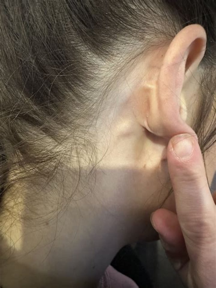 Why do I have a lump inside my earlobe?