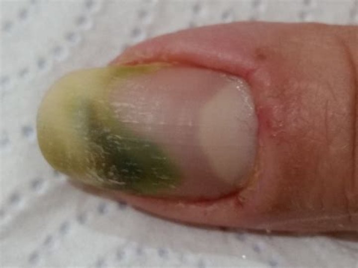 Why is there a green spot on my nail?